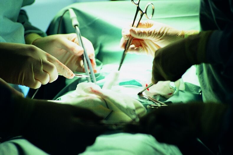 chirurgiczne zwiększenie grubości penisa